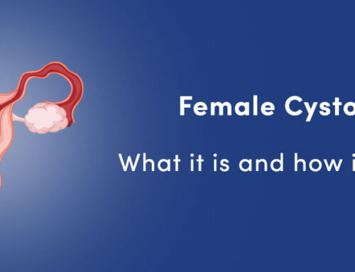 Female Cystocele: What it is and how it is treated