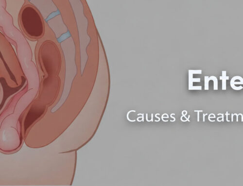 Enterocele: Causes & Treatment methods